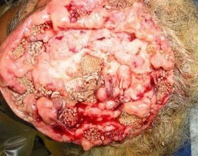 Des parasites dans le cerveau humain